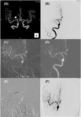 Endovascular Therapy for Acute Ischemic Stroke of Intracranial Atherosclerotic Origin—Neuroimaging Perspectives